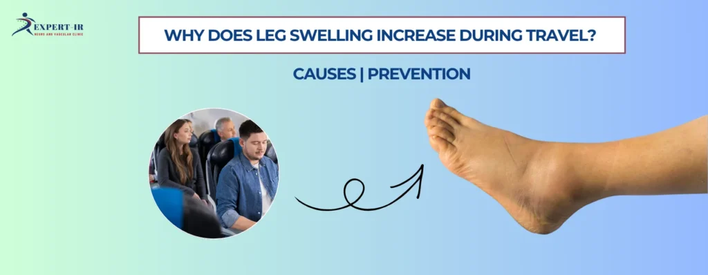 Why Does Leg Swelling Increase During Travel