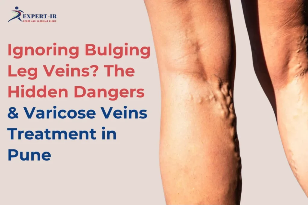 Bulging Leg Veins treatment in pune