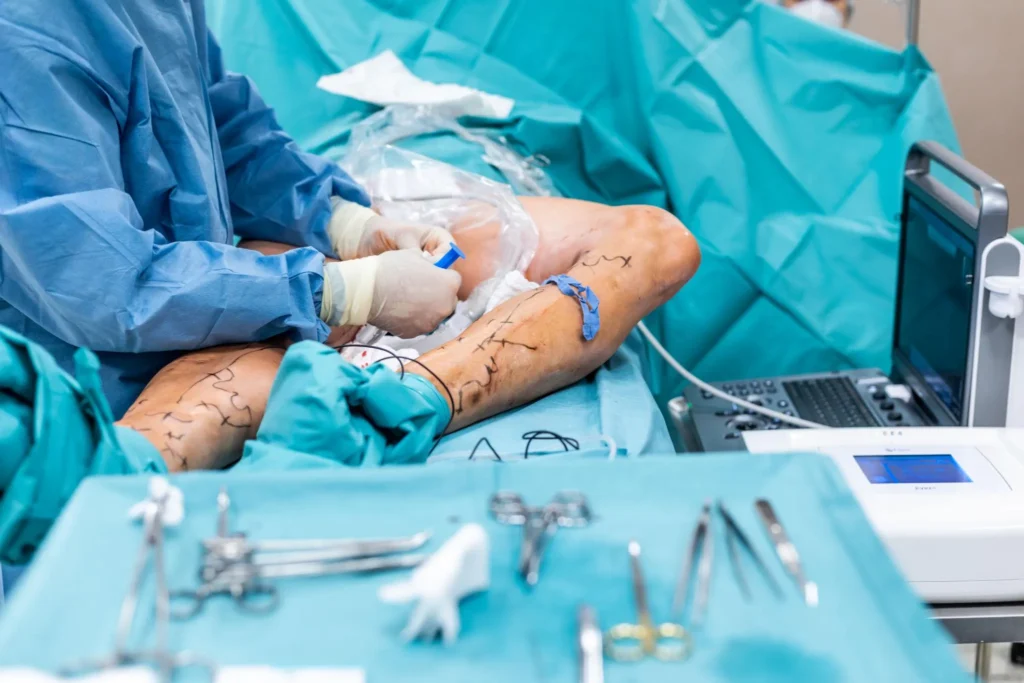 Does Insurance Cover Laser Treatment for Varicose Veins