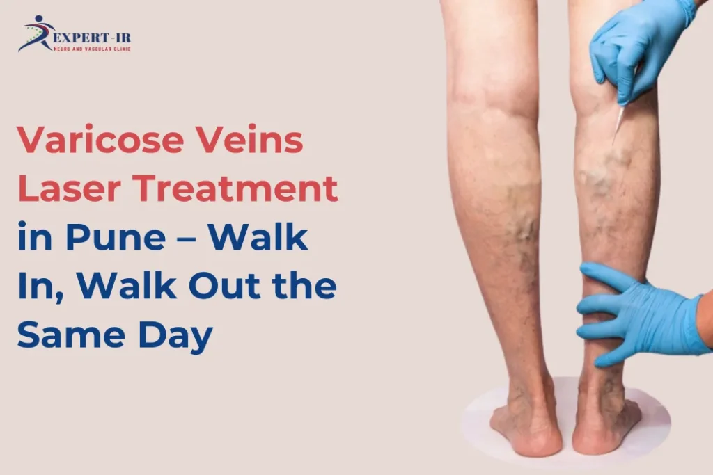 Varicose Veins Laser Treatment in Pune