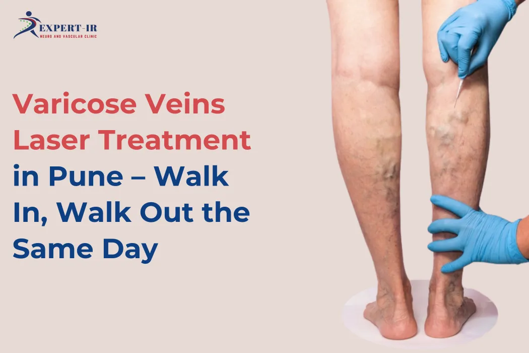 Varicose Veins Laser Treatment in Pune
