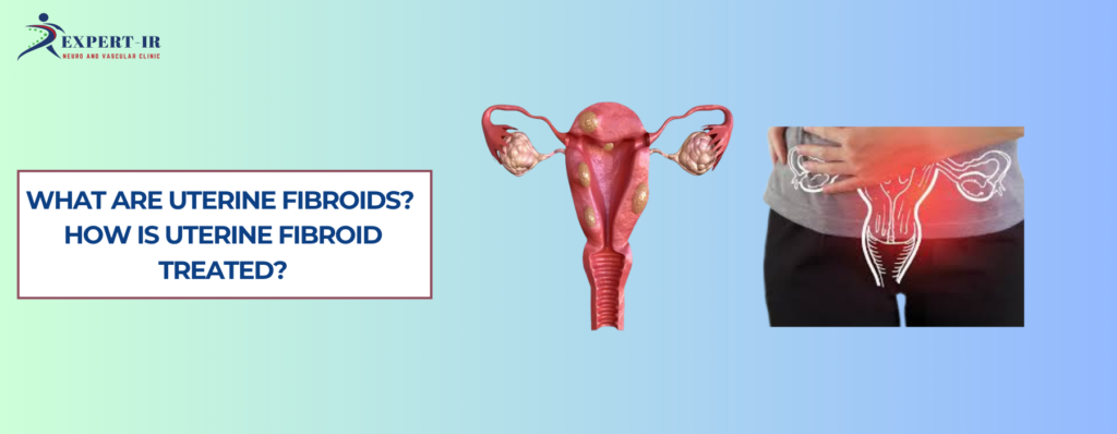 Uterine fibroid embolization in PuneWhat Are Uterine Fibroids? Understanding the Condition
