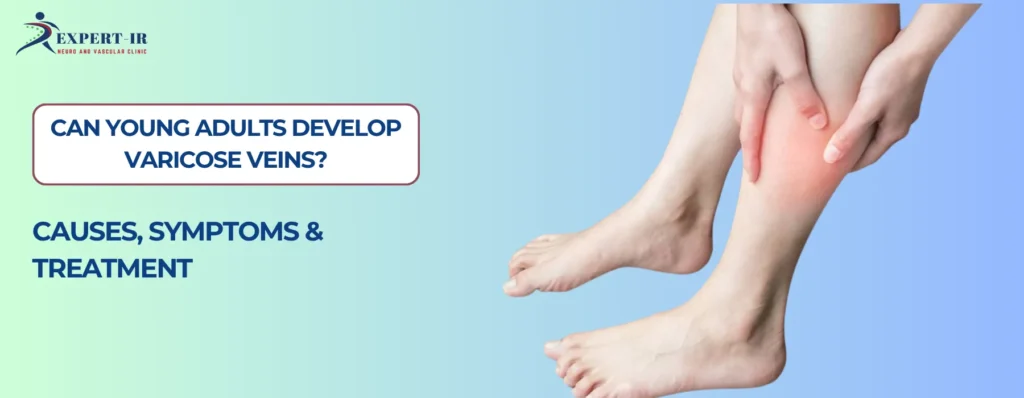 Can Young Adults Develop Varicose Veins