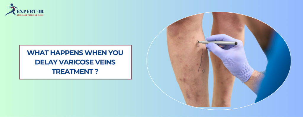 varicose veins treatment in Pune 6 stages delay consequences Expert IR