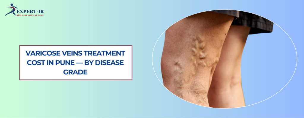 varicose veins treatment cost in Pune EVLA laser vs surgery Expert IR