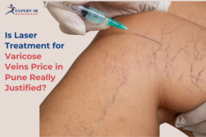 laser treatment for varicose veins price in Pune Expert IR cost breakdown