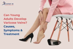 Varicose veins in young adults