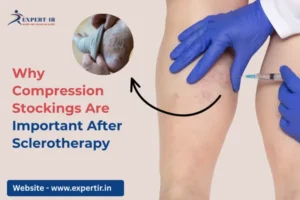 Compression Stockings After Sclerotherapy