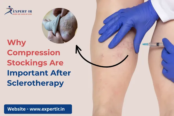 Compression Stockings After Sclerotherapy