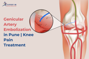 Genicular Artery Embolization for knee pain