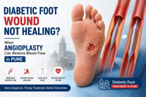 angioplasty for diabetic foot