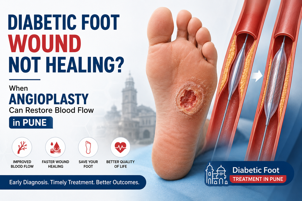 angioplasty for diabetic foot