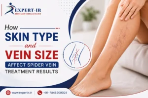 How Skin Type and Vein Size Affect Spider Vein Treatment Results