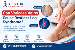 Varicose Veins