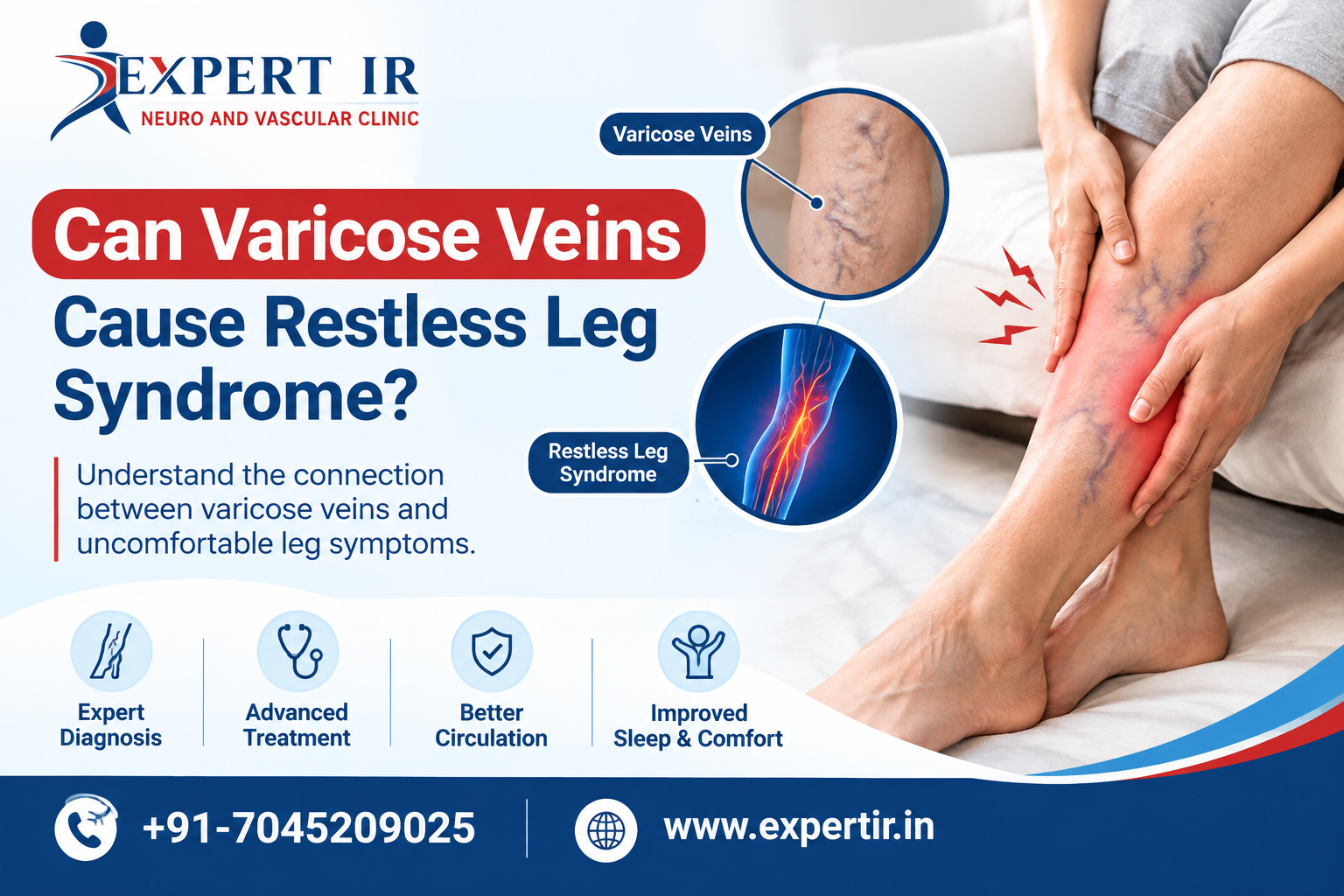 Varicose Veins