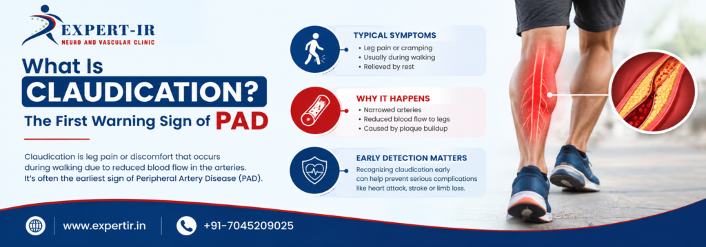 What Is Claudication