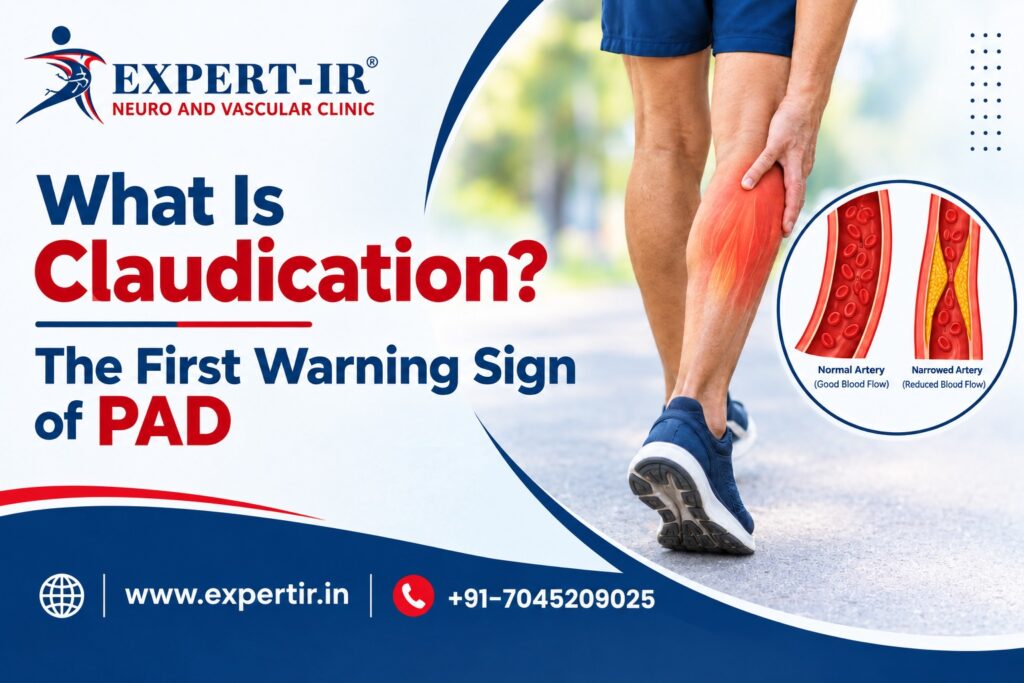 What Is Claudication The First Warning Sign of PAD