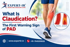 What Is Claudication The First Warning Sign of PAD