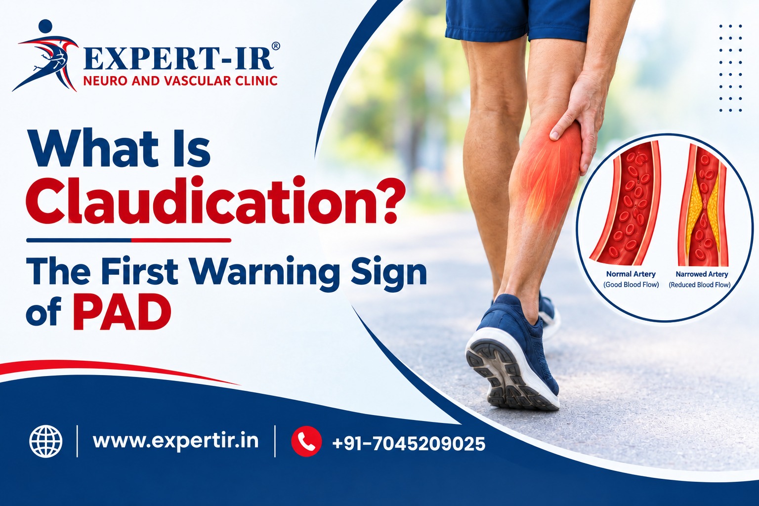 What Is Claudication The First Warning Sign of PAD