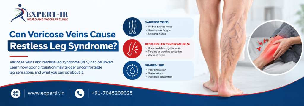 Varicose Veins