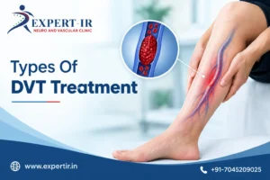 DVT Treatment in Pune, Diagnosis, Treatment Options and Recovery