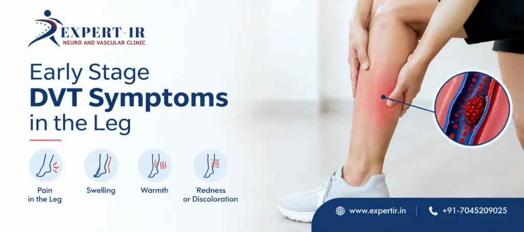 Early Stage DVT Symptoms in the Leg, Including Swelling and Pain