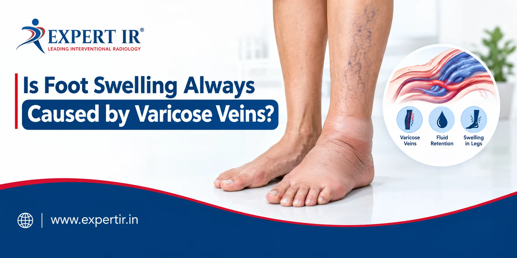 Swollen feet and varicose veins – symptoms and causes