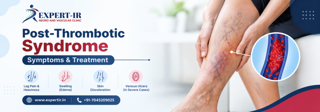 Vein Damage and Blood Pooling
