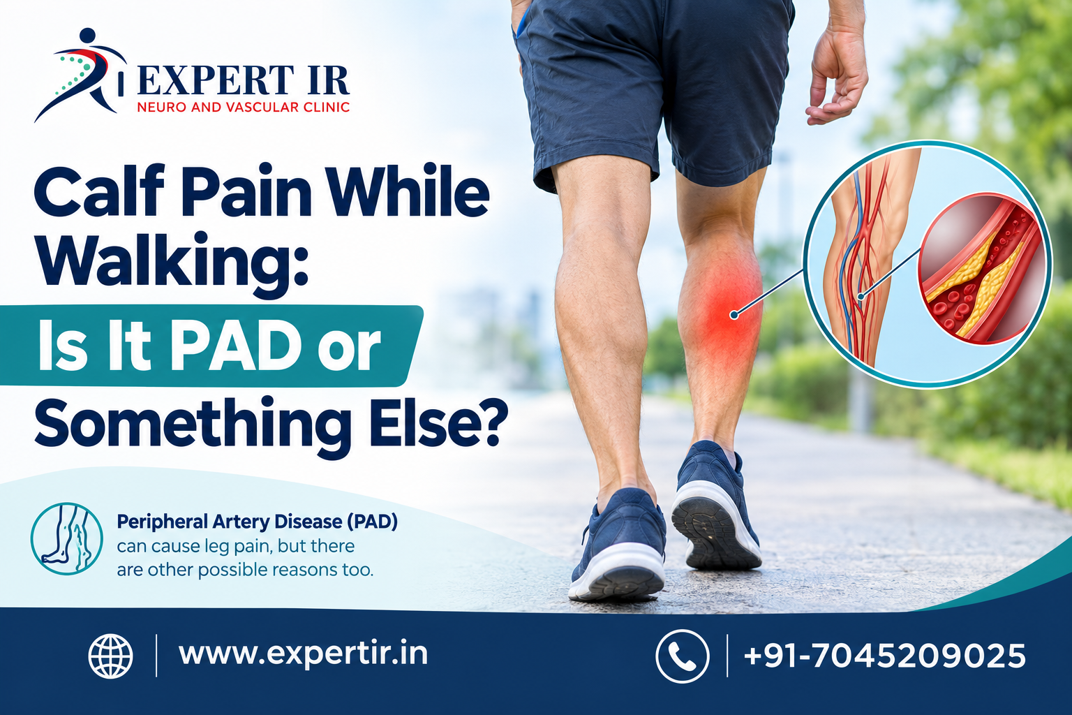 Calf Pain While Walking: Is It PAD or Something Else?