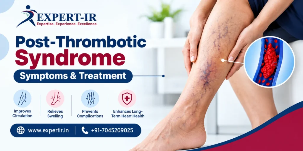 Post-Thrombotic Syndrome symptoms and treatment for leg swelling and vein problems